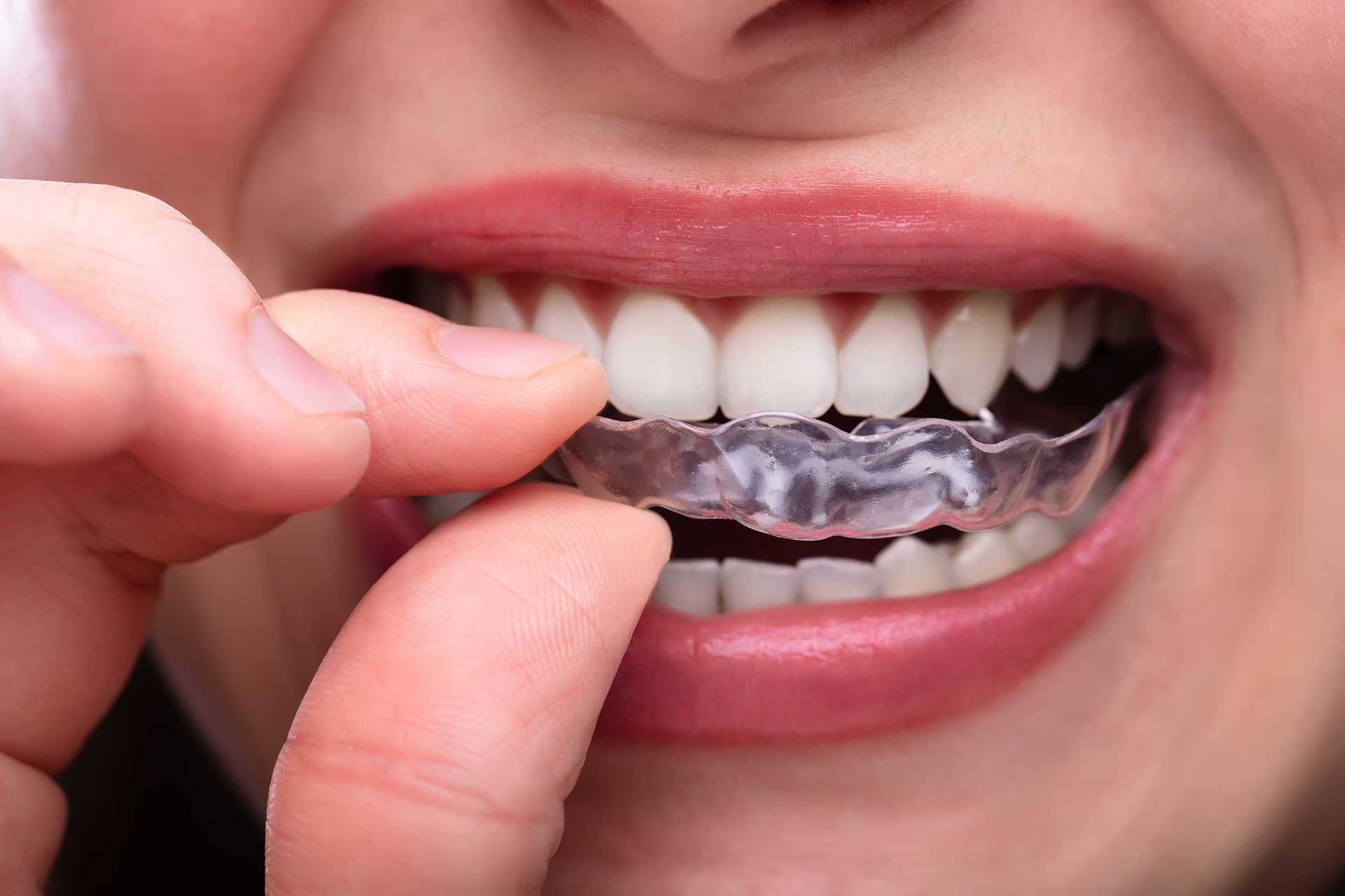Clear dental aligners