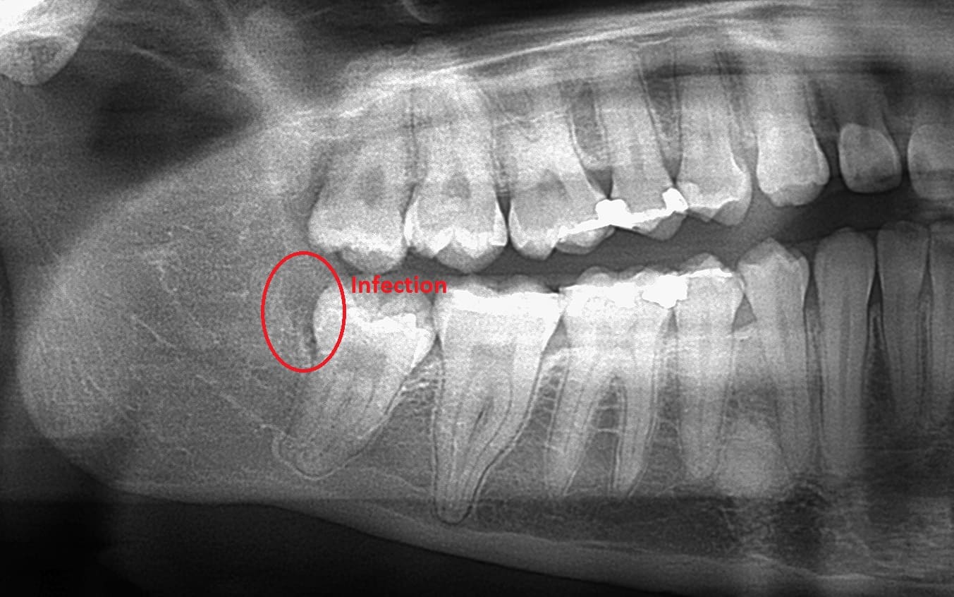 dental x-ray gum disease