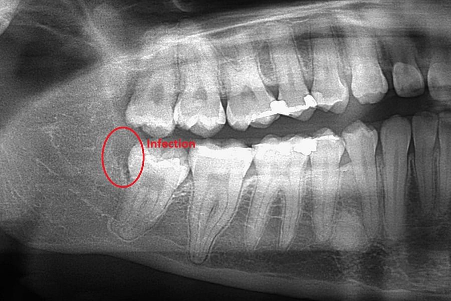 dental x-ray gum disease