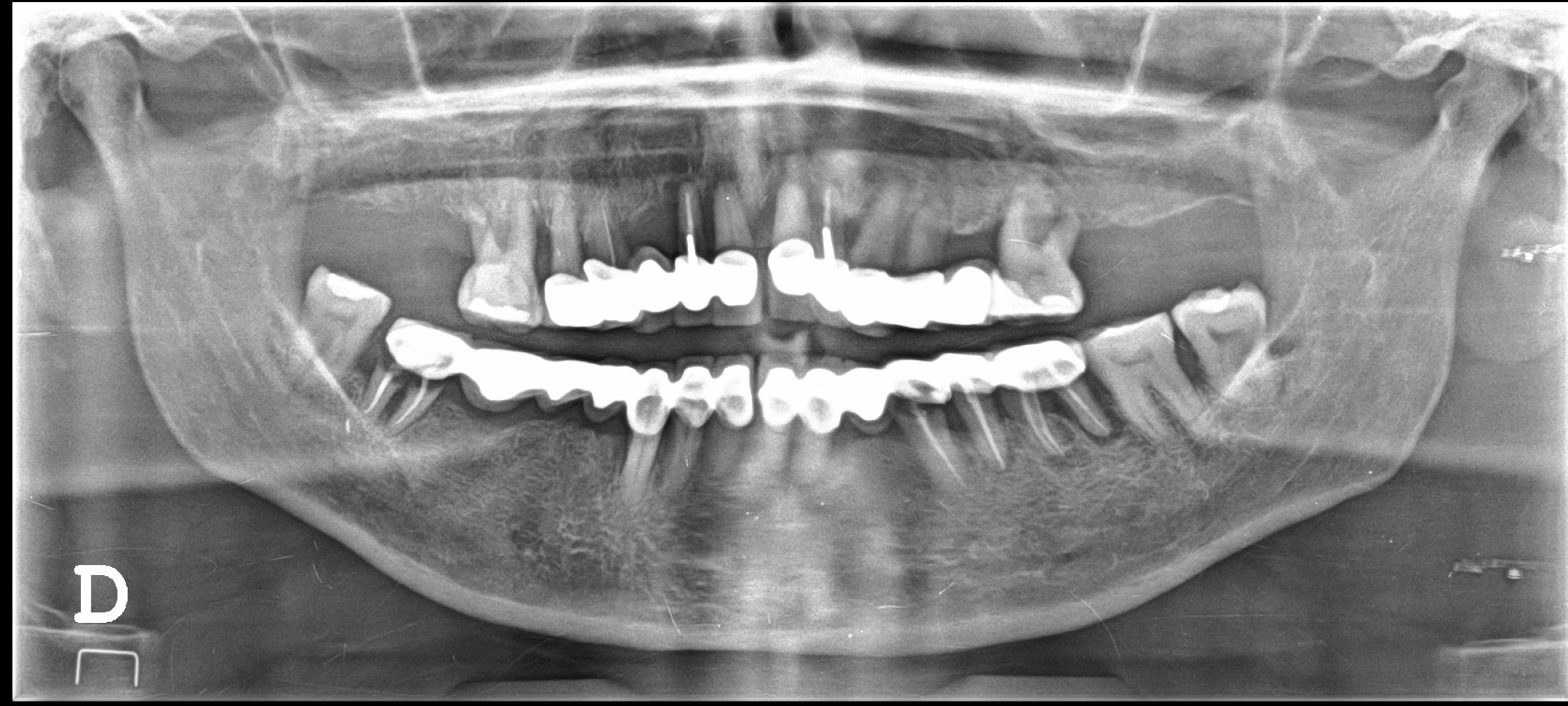 dental x-ray impacted wisdom tooth