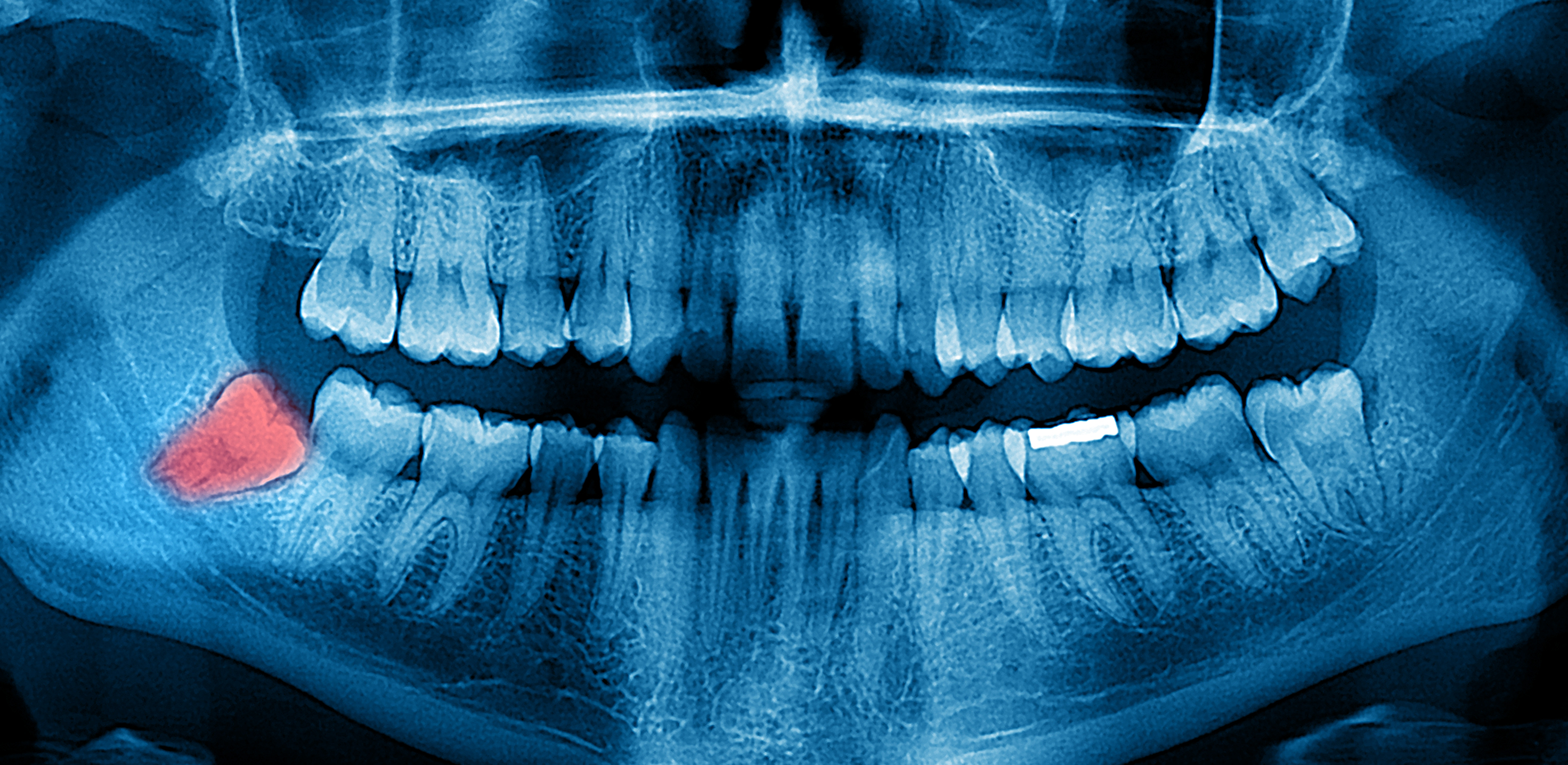 dental x-ray jaw tumors