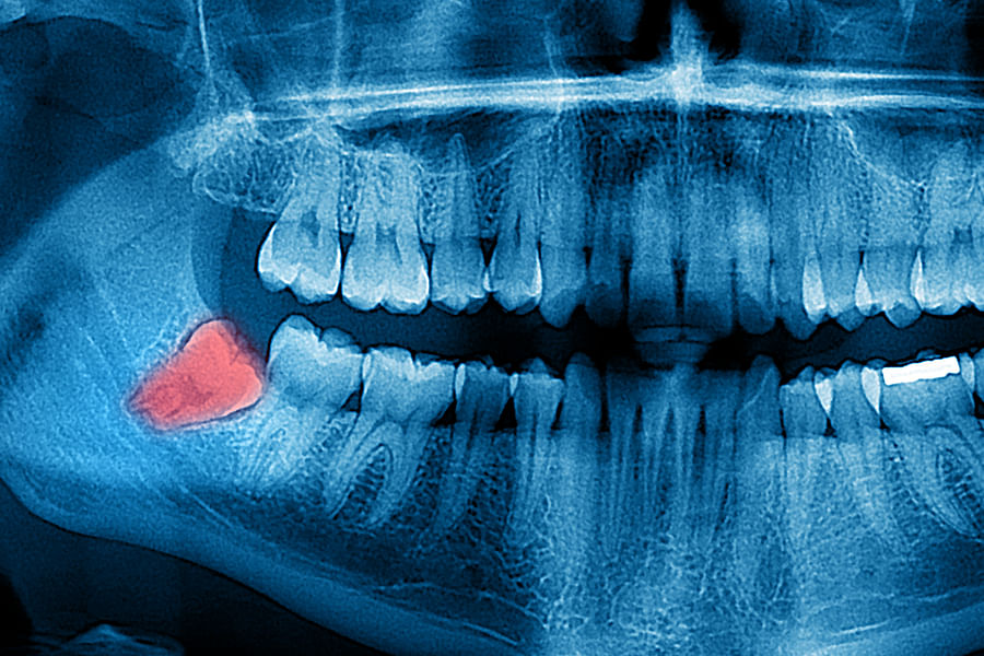 dental x-ray jaw tumors