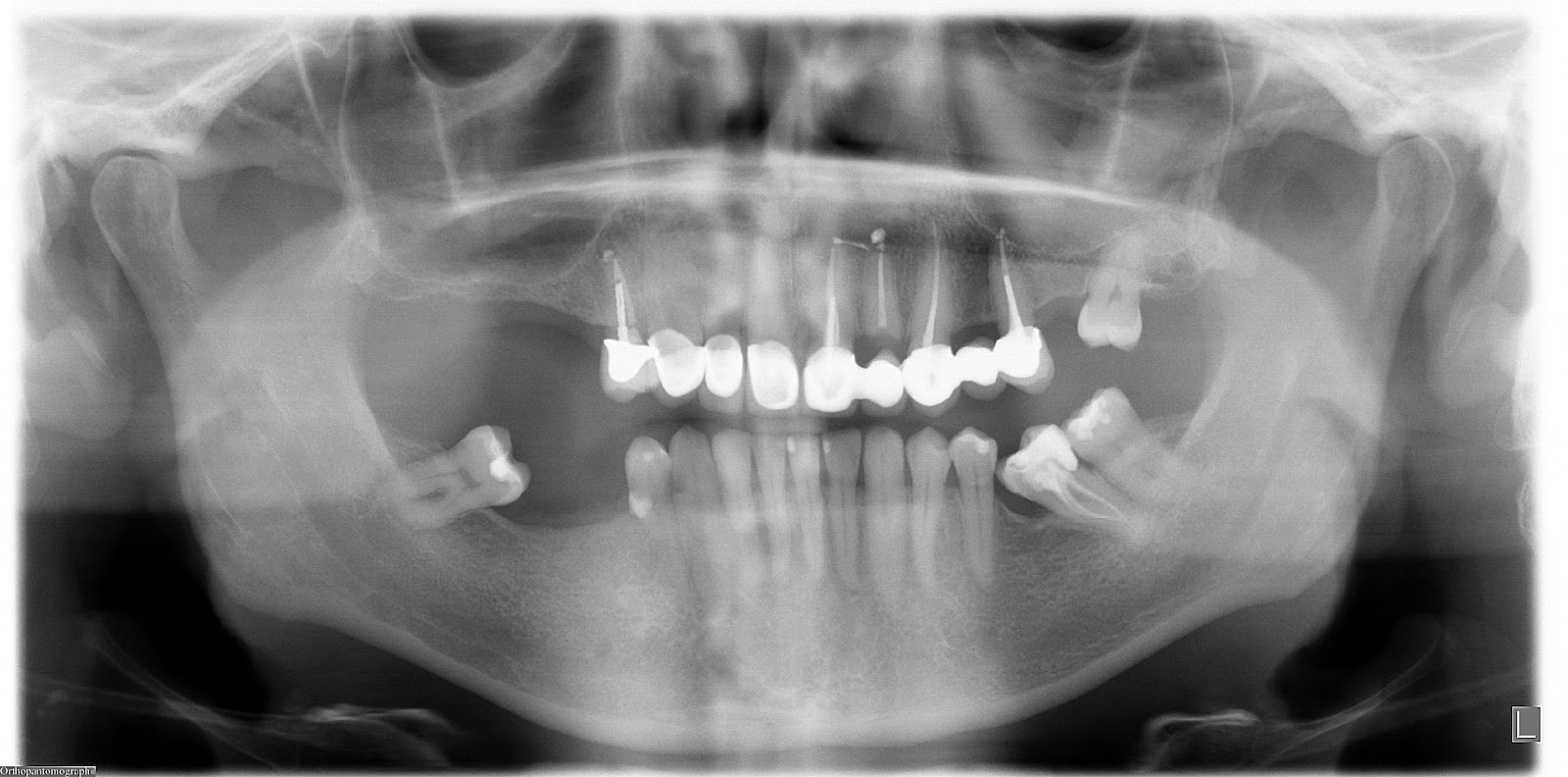 dental x-ray pre-implant assessment