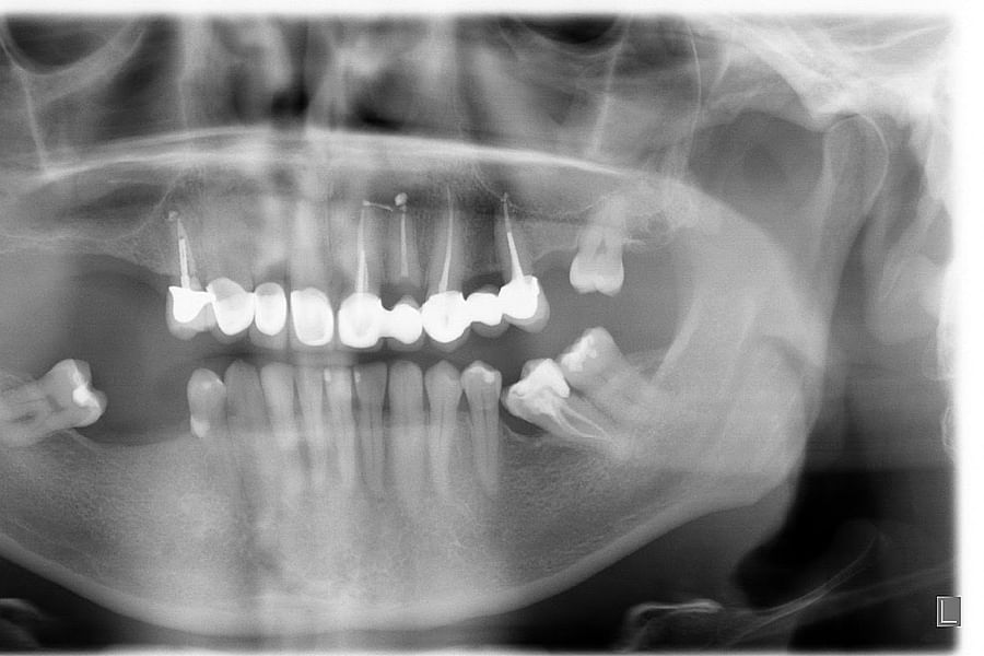 dental x-ray pre-implant assessment