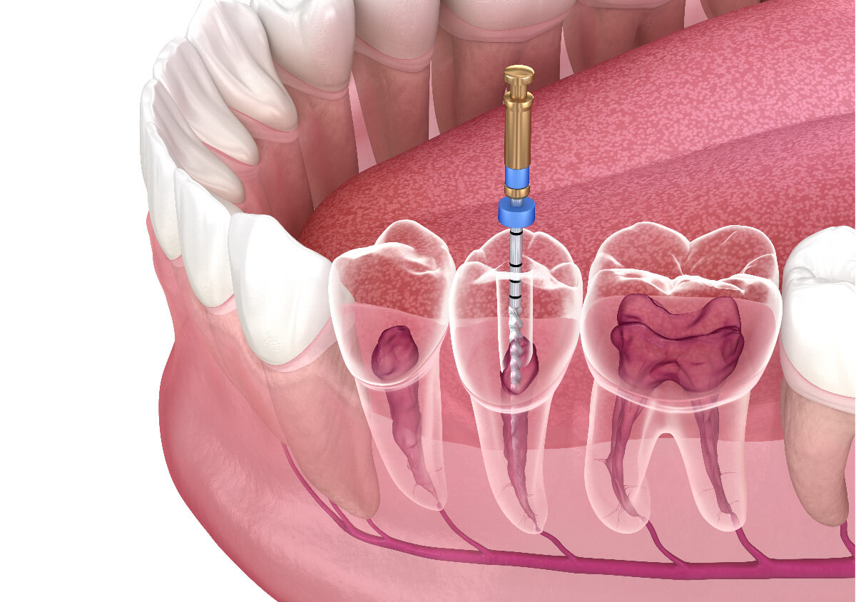 dental x-ray root infection