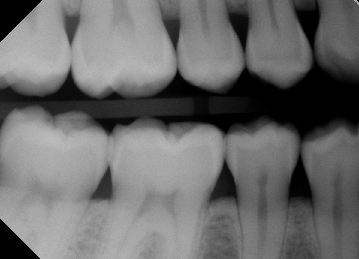 dental x-ray showing cavities