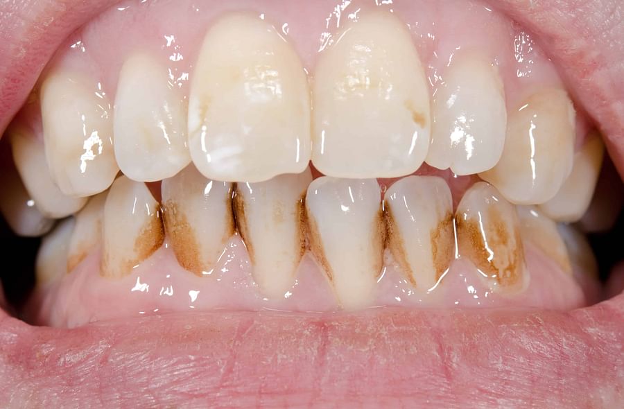 Close-up of stained teeth from smoking