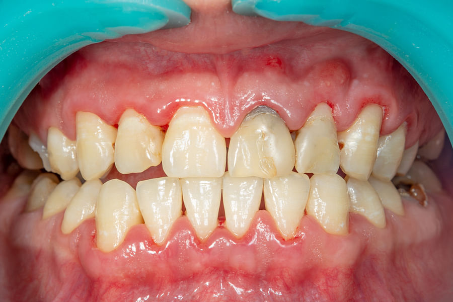 Comparison between healthy gums and gums affected by gum disease