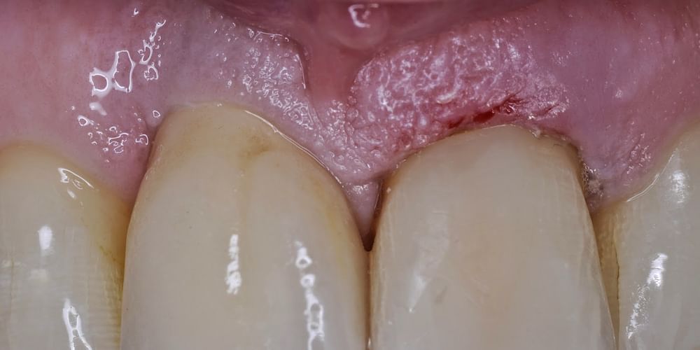 What should I do if the local anesthesia doesn't work during a dental