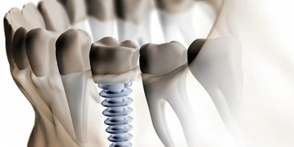 Where can I find affordable dental implants?