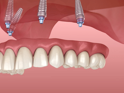 A & B Dental - Cosmetic and Implant Dentistry