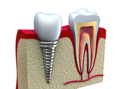 Advanced Restorative Dentistry