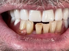 Affordable Dentures & Implants