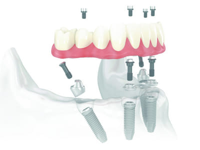 Bay Lakes Center for Complex Dentistry