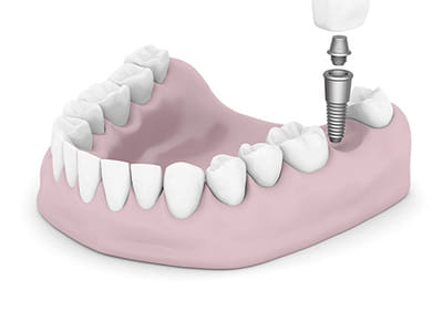 Bay Lakes Center for Complex Dentistry