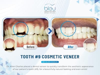 Bleu Dentistry Invisalign Cosmetic Veneers Emergency Implants