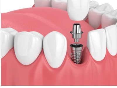 Brooklyn Smile | Cosmetic & Dental Implant Dentist