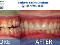 Burleson Smiles Dentistry