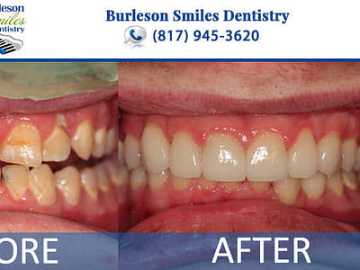 Burleson Smiles Dentistry