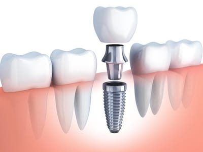 Cedar Hills Family Dentistry