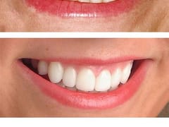 Chapel Hill Dental Care - Joseph G. Marcius, DDS