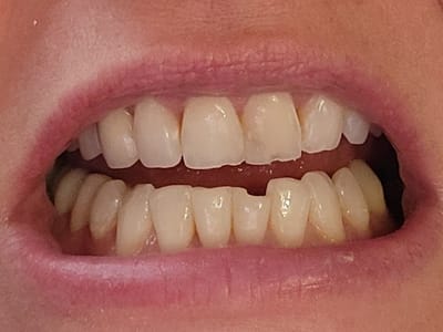 Cosmetic Dentist, Dental Implants & Dentures by Bakersfield Smile Design | Dr. Kenneth W Krauss DDS