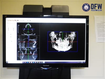 DFW Dental Service Invisalign Family Cosmetic Implants