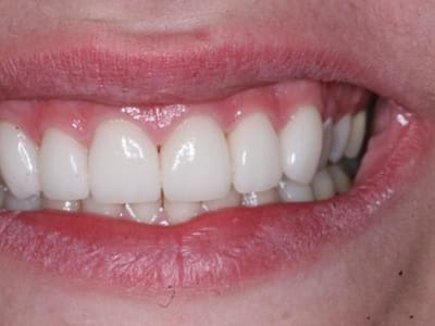 Elite Dental American Fork | Dentist & Implants