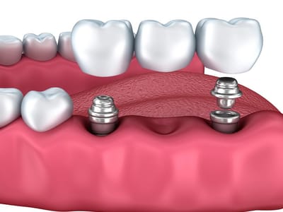 Gates Family Dentistry of Wilsonville PC