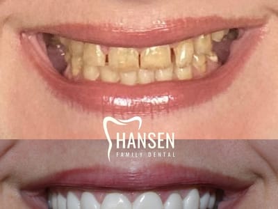 Hansen Family Dental
