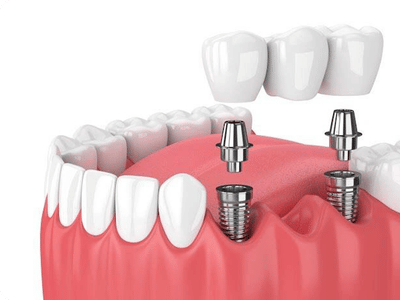 Implantation Dentistry