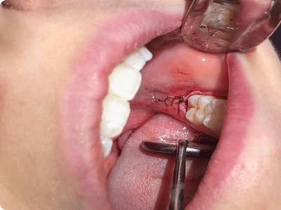 Implantation Dentistry