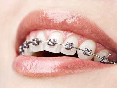 Lone Star Dental and Braces Dallas