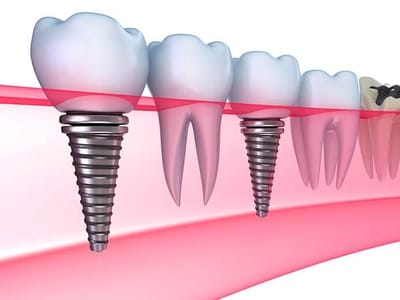 Off Island Dental Care - Cosmetic and Implant Dentistry Bluffton