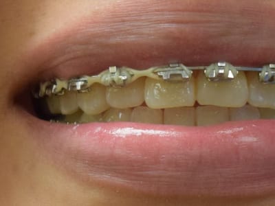 Pagosa Smiles FASTBRACES & Dentistry