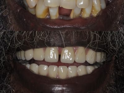 Restorative and Implant Dentistry Pompano Beach