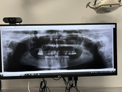 Secure Dentures & Implants