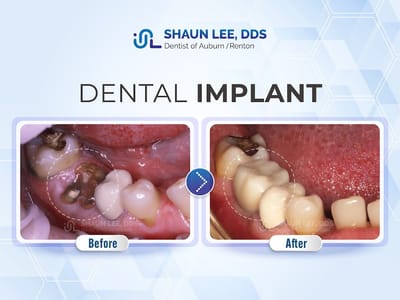 Shaun Lee DDS: Dental Implant and General Dentistry of Renton