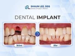 Shaun Lee DDS: Dental Implant and General Dentistry of Renton
