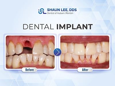 Shaun Lee DDS: Dental Implant and General Dentistry of Renton