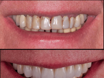 Smile Design Center | Dentist In Croton on Hudson NY | Implant Dentist