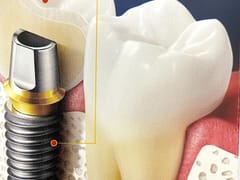 Smile For Success Dental Center - Tim Do Nha Khoa Lab Denture, Implant & Crown