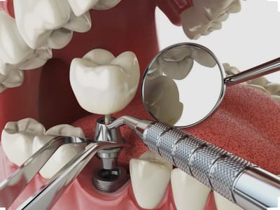 The Center for Implant & General Dentistry