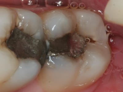 Young Family Dental Riverton